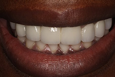 Closeup of dental patient after treatment