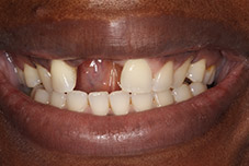 Closeup of dental patient before treatment