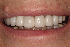 Closeup of smile after treatment