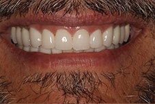 Closeup of John P's smile after treatment