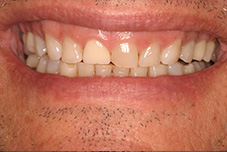 Before image of worn down teeth from clenching and grinding