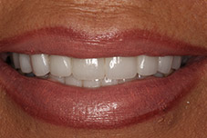 Closeup of smile after treatment