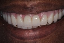 Closeup of Mary Ann after Long Island implant dentures