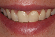Closeup of Jackie's smile before treatment