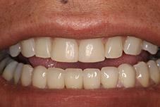 Closeup of teeth after treatment
