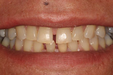 Woman's damaged smile before treatment