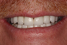 Closeup of Bart's smile after treatment