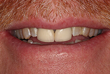 Closeup of Bart's smile before treatment
