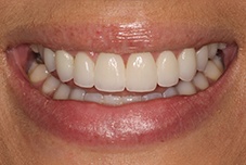 July 2017 patient closeup after gummy smile treatment