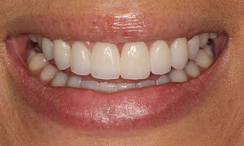 Gummy Smile Treatment Long Island - Esthetic Gum Contouring