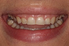 Closeup of Brittany's smile before treatment