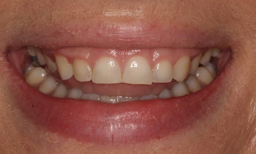 Gummy Smile Treatment Long Island - Esthetic Gum Contouring