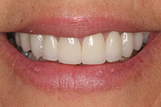 Closeup of smile from front after