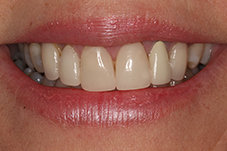 Closeup of smile from front before