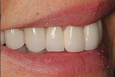 Closeup of smile from left after
