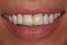May 2017 closeup front of teeth before