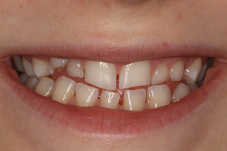 Closeup of Chelsea's smile from front before