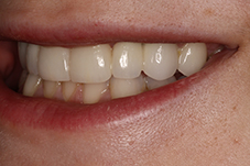 November 2017 dental implant patient side closeup after