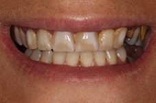 October 2017 dental implant patient front closeup before