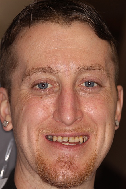 Man with missing front teeth before implants