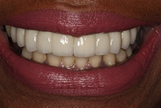 Closeup of Tajuana's smile after treatment