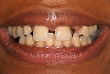 Closeup of Tajuana's smile before treatment