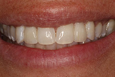 September 2016 patient with repaired top teeth closeup