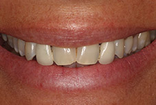 Closeup woman's damaged smile before treatment