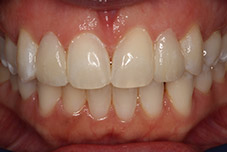Closeup of Darlene's top teeth after treatment