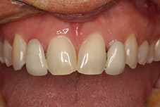 Closeup of Darlene's top teeth before treatment