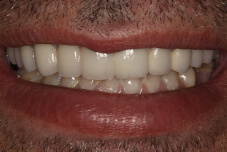Closeup of James' smile after treatment