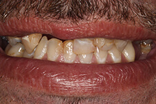 Closeup of James' smile before treatment
