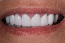 September 2020 gummy smile correction dental  patient after treatment closeup