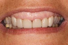 Gummy smile before gum recontouring on Long Island