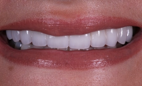 closeup of Taylor's beautiful teeth after her cosmetic work