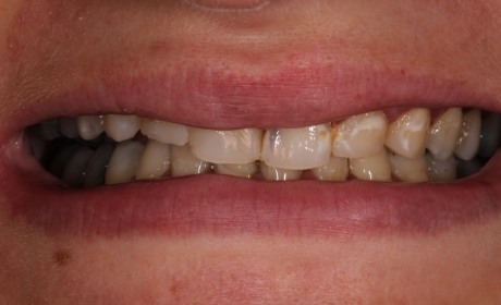 closeup of Taylor's yellowed smile before her cosmetic work