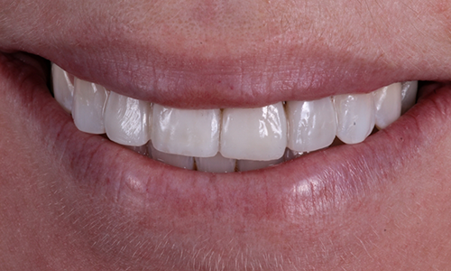 Close-up of teeth that have been restored with dental crowns