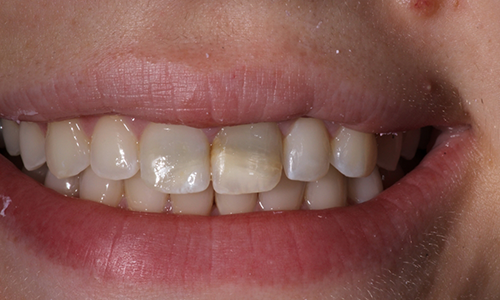 Close-up of smile with teeth darkened in upper areas