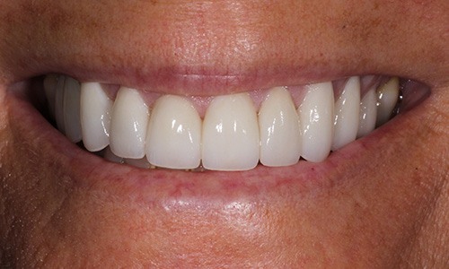Closeup of Chanique after Long Island veneers