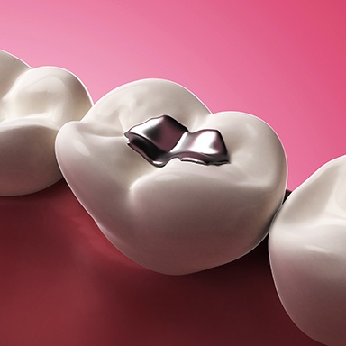 Animation of tooth with silver filling