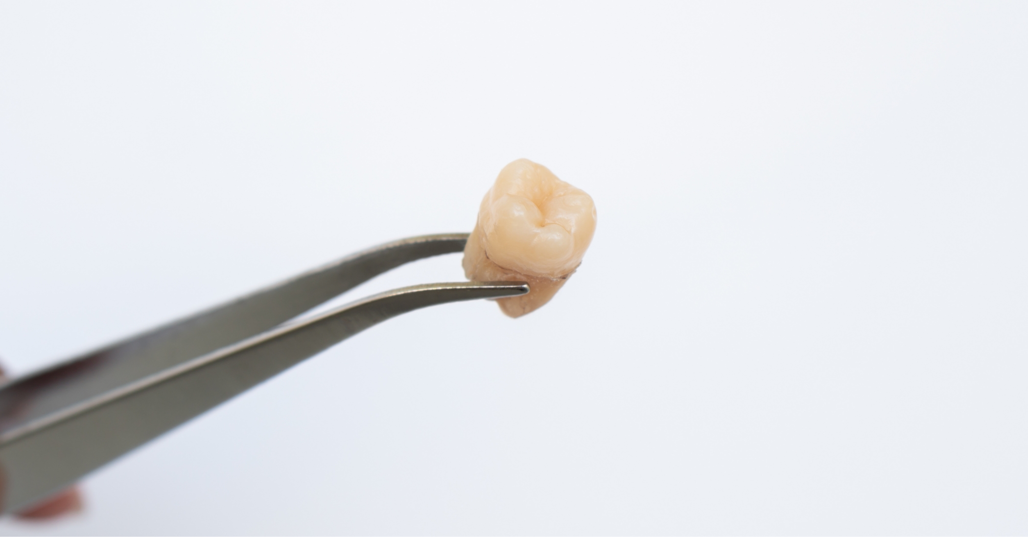 Tweezers holding an extracted tooth