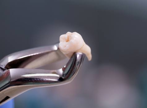 Dental mirror next to a model of a severely decayed tooth