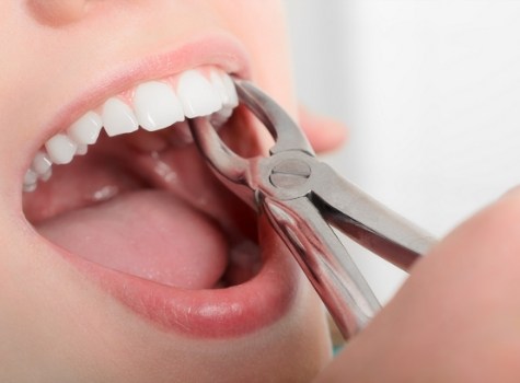 Doctor Ariel performing a tooth extraction on a Massapequa Park dental patient