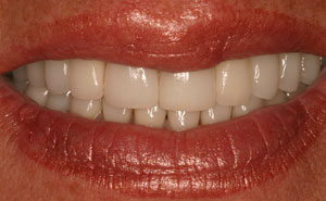 White teeth closeup