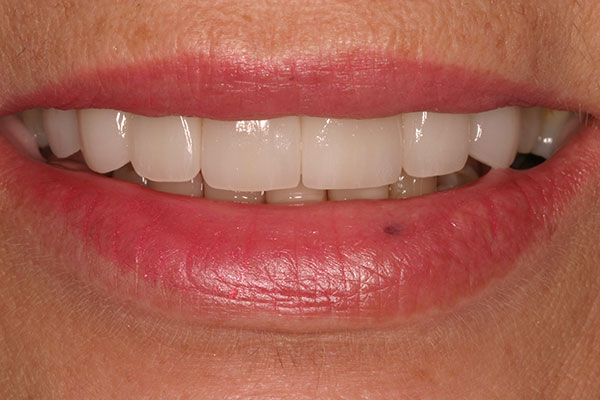 Closeup beautiful healthy top teeth
