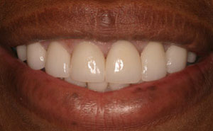 Smile with white teeth and healthy gums