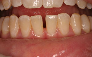 Closeup damaged bottom teeth