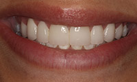 Woman with healthy gums closeup after treatment