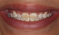 Woman with gummy smile closeup before treatment