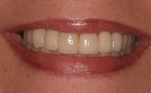 Closeup of white teeth